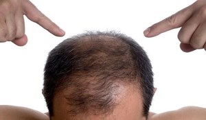 Почему выпадают волосы у мужчин